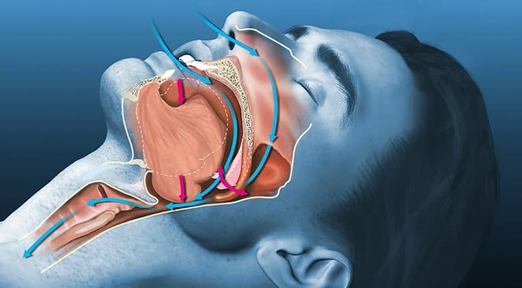 Apnea obstructiva del sueño (síndrome de apnea-hipopnea del sueño)