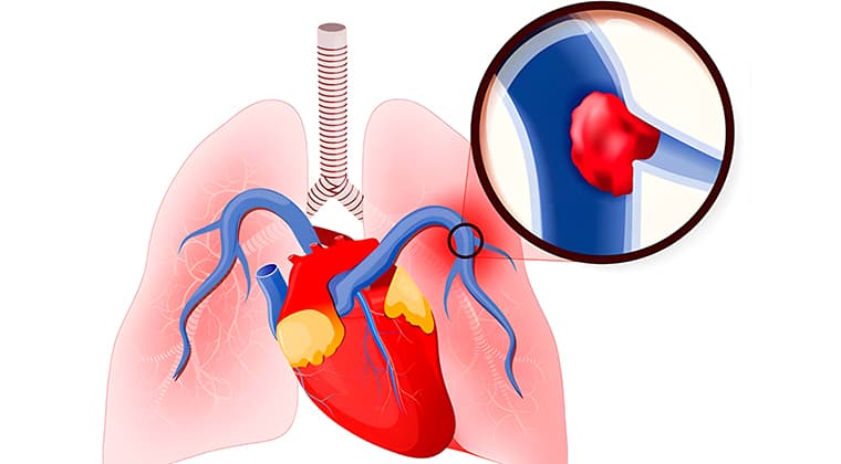 Embolia pulmonar