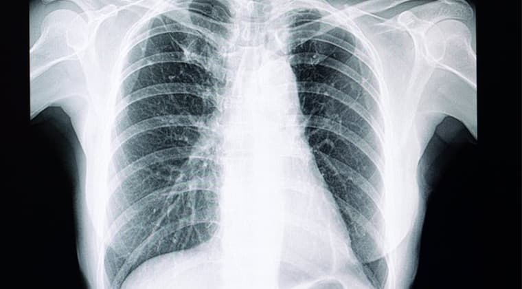 Fibrosis pulmonar