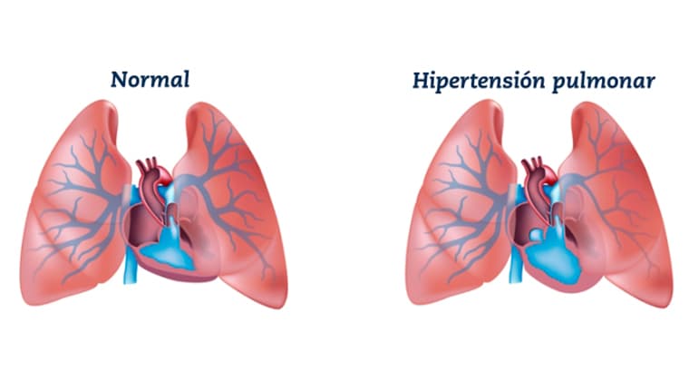 Hipertensión pulmonar