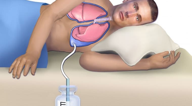 Pleurodesis