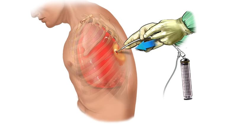 Toracocentesis