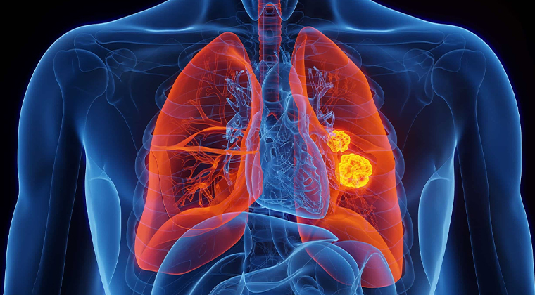 Fondo de Cáncer de pulmón